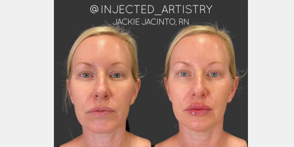 Lip filler by Jackie Jacinto RN