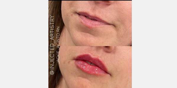 Lip filler by Jackie Jacinto RN