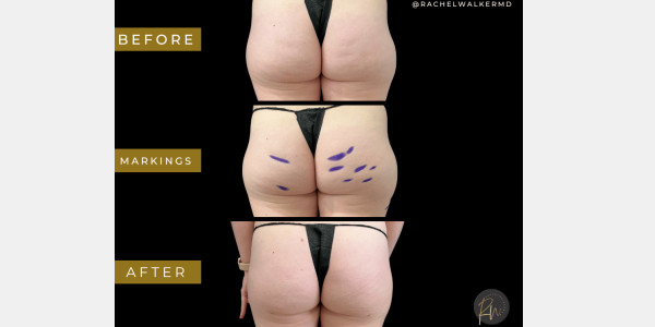 Case #6877 – Cellulite