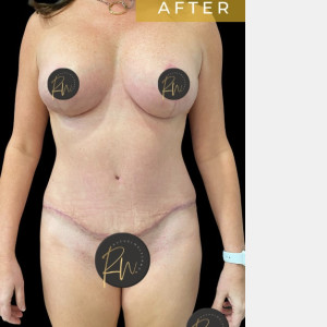 After Image: Case #6883 – Breast Lift with Breast Augmentation - front