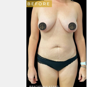 Before Image: Case #6883 – Breast Lift with Breast Augmentation - front