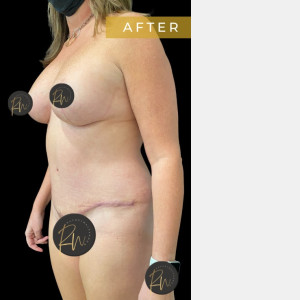 After Image: Case #6884 – Abdominoplasty - left-front-oblique