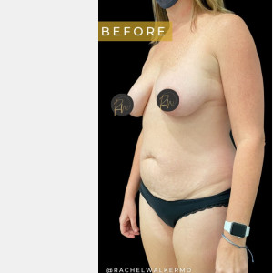 Before Image: Case #6884 – Abdominoplasty - left-front-oblique