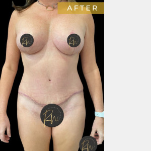 After Image: Case #6884 – Abdominoplasty - front