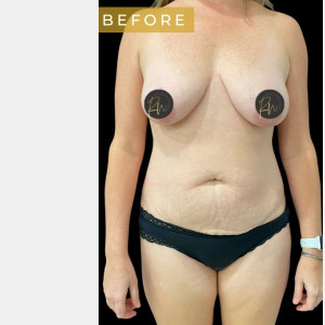 Before Image: Case #6884 – Abdominoplasty - front
