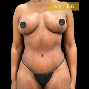 After Image: Case #6898 – Breast Lift - front
