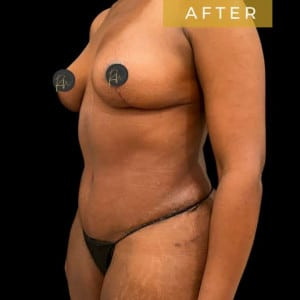 After Image: Case #6898 – Breast Lift - left-front-oblique