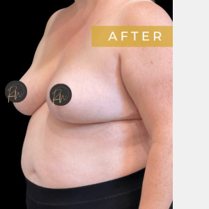 After Image: Case #6945 Breast reduction with SAFELipo of lateral chest wall - left-front-oblique