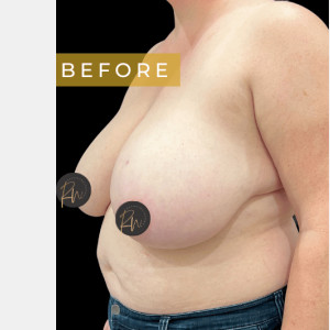 Before Image: Case #6945 Breast reduction with SAFELipo of lateral chest wall - left-front-oblique