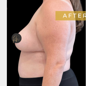After Image: Case #6945 Breast reduction with SAFELipo of lateral chest wall - other