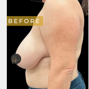 Before Image: Case #6945 Breast reduction with SAFELipo of lateral chest wall - other