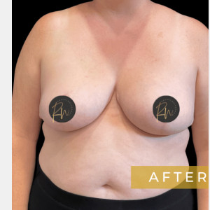 After Image: Case #6945 Breast reduction with SAFELipo of lateral chest wall - front