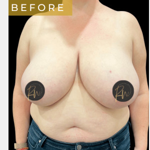 Before Image: Case #6945 Breast reduction with SAFELipo of lateral chest wall - front