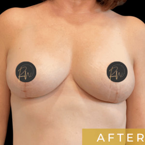 After Image: Case #6958- Breast reduction with SAFELipo of lateral chest wall - front