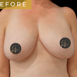 Before Image: Case #6958- Breast reduction with SAFELipo of lateral chest wall - front