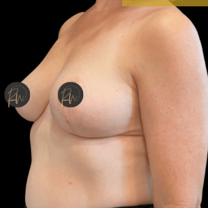 After Image: Case #6958- Breast reduction with SAFELipo of lateral chest wall - left-front-oblique