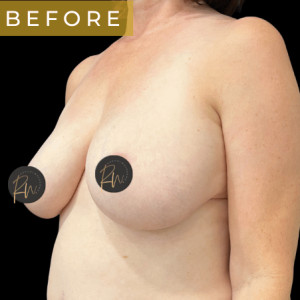 Before Image: Case #6958- Breast reduction with SAFELipo of lateral chest wall - left-front-oblique