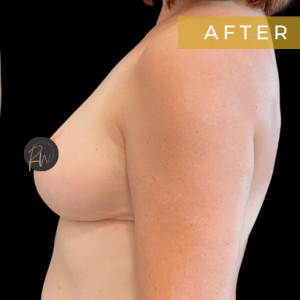 After Image: Case #6958- Breast reduction with SAFELipo of lateral chest wall - other