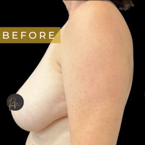 Before Image: Case #6958- Breast reduction with SAFELipo of lateral chest wall - other