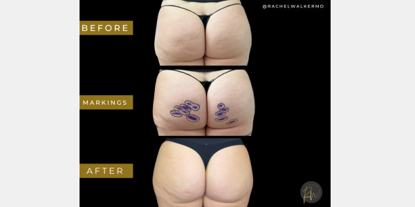 Case #7056 – Aveli Cellulite Treatment