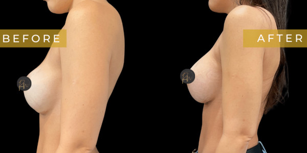 Case #7068 – Breast Pocket Revision with Galaflex