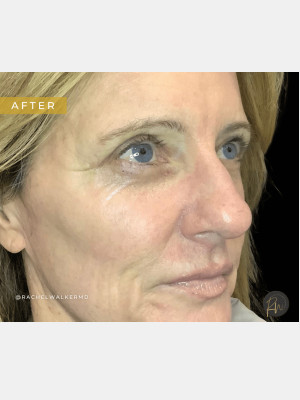 After Image: Case #7094 – Upper Eyelid Lift, Facial Fat Transfer, Laser Resurfacing with Radiofrequency Microneedling, Trifecta Profound - right-front-oblique