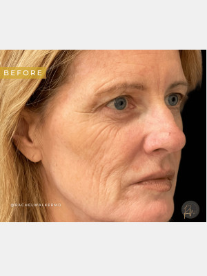 Before Image: Case #7094 – Upper Eyelid Lift, Facial Fat Transfer, Laser Resurfacing with Radiofrequency Microneedling, Trifecta Profound - right-front-oblique