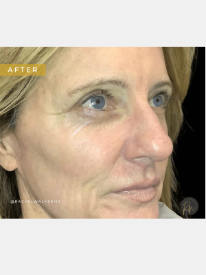 After Image: Case #7102 – Upper Eyelid Lift, Facial Fat Transfer, Laser Resurfacing with Radiofrequency Microneedling, Trifecta Profound - right-front-oblique