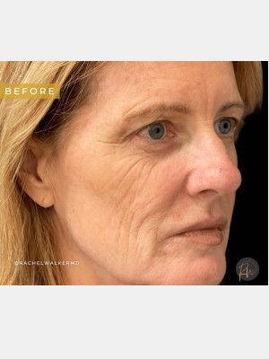 Before Image: Case #7102 – Upper Eyelid Lift, Facial Fat Transfer, Laser Resurfacing with Radiofrequency Microneedling, Trifecta Profound - right-front-oblique