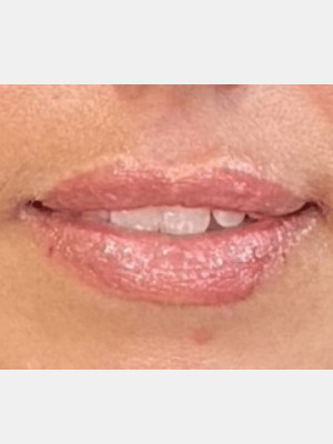 After Image: Lip Filler - other