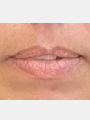 Before Image: Lip Filler - other