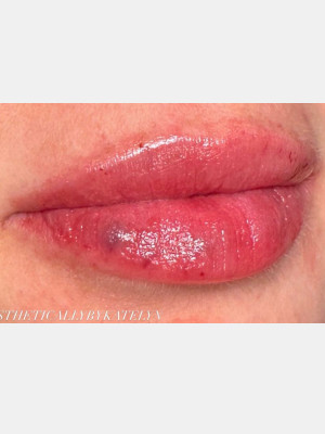 Lip Filler with Katelyn Gross, Rn