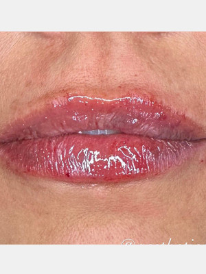 After Image: Lip Filler with Katelyn Gross, Rn - front