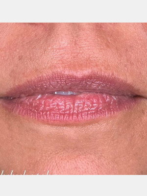 Before Image: Lip Filler with Katelyn Gross, Rn - front