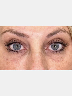 Under eye Filler with Katelyn, RN