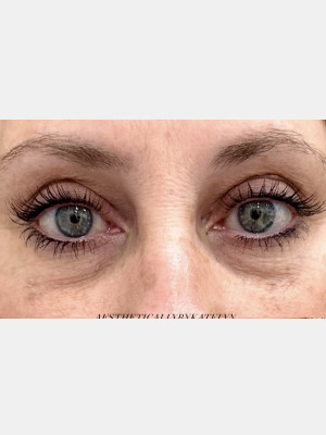 Under eye Filler with Katelyn, RN