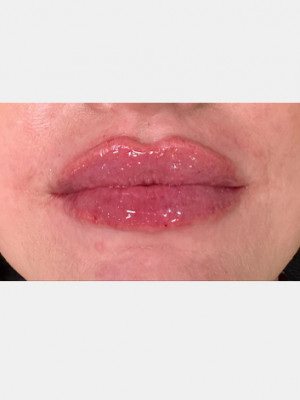 After Image: Lip Filler with Katelyn, BSN RN - front