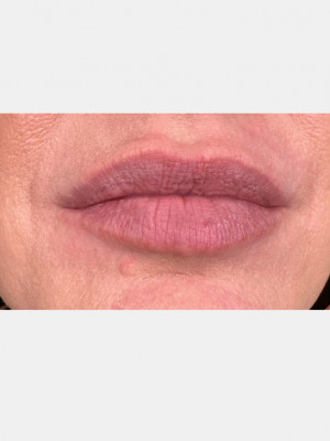 Before Image: Lip Filler with Katelyn, BSN RN - front