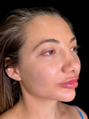 After Image: Dissolved and Refilled Lips, Chin Filler, Jawline Filler - right-front-oblique