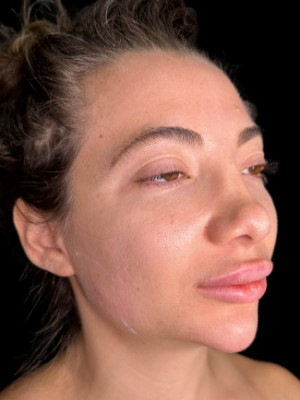 Before Image: Dissolved and Refilled Lips, Chin Filler, Jawline Filler - right-front-oblique