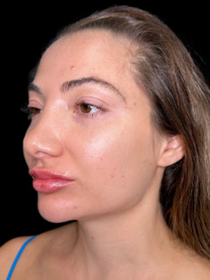 After Image: Dissolved and Refilled Lips, Chin Filler, Jawline Filler - left-front-oblique
