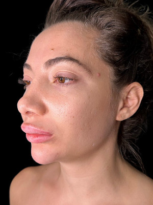 Before Image: Dissolved and Refilled Lips, Chin Filler, Jawline Filler - left-front-oblique