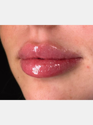 After Image: Lip Filler with Katelyn, RN - left-front-oblique