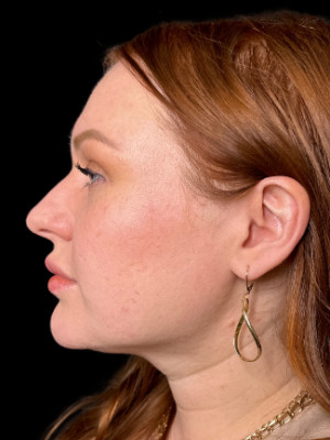 After Image: Jawline Filler with Katelyn, RN - left-side