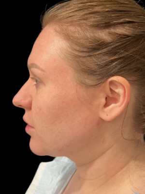 Before Image: Jawline Filler with Katelyn, RN - left-side