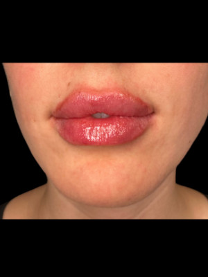 After Image: Lip Filler with Katleyn, RN - other