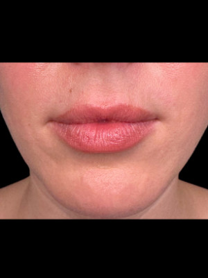 Before Image: Lip Filler with Katleyn, RN - other