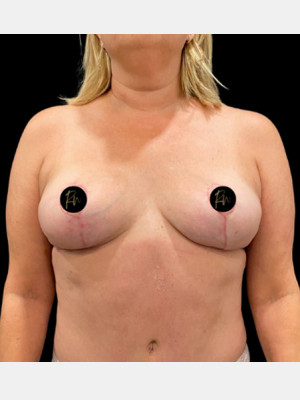 After Image: Case #7427 – Breast Revision and Correction - front