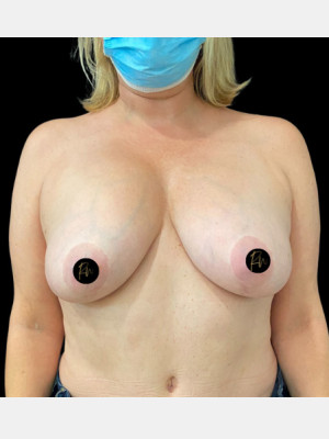Before Image: Case #7427 – Breast Revision and Correction - front