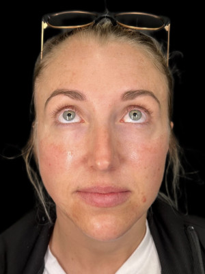 After Image: Cheek and Chin Filler with Katelyn, RN - front
